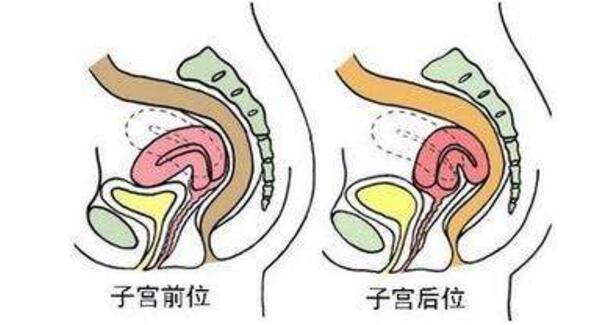 子宫移位是怎么回事