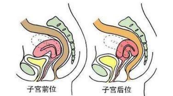 子宫移位怎么办  第1张