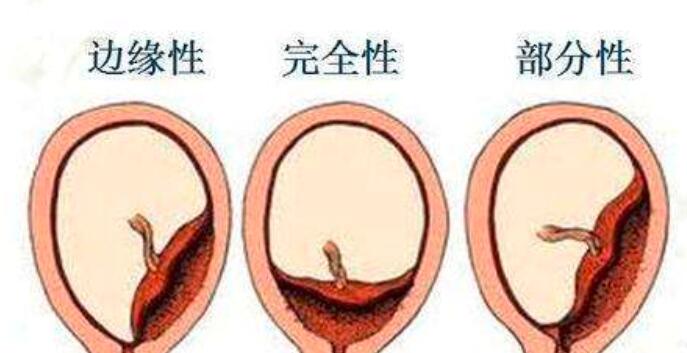 胎盘低怎么护理_胎盘低的注意事项  第2张