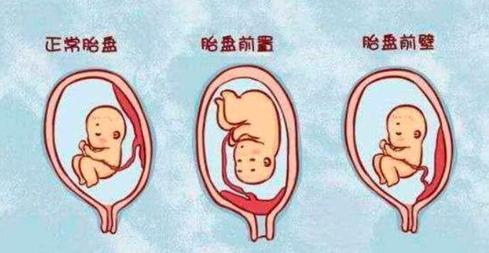 胎盘低位置怎么办_胎盘低位置的食疗方法  第4张