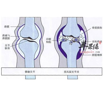 冬季防治关节炎我们可以这样做  第1张