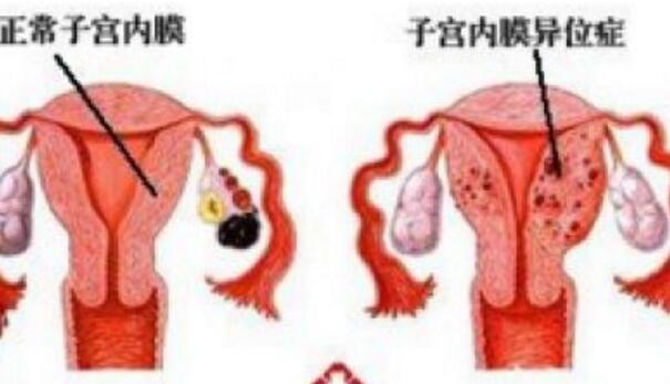 子宫移位怎么办  第2张