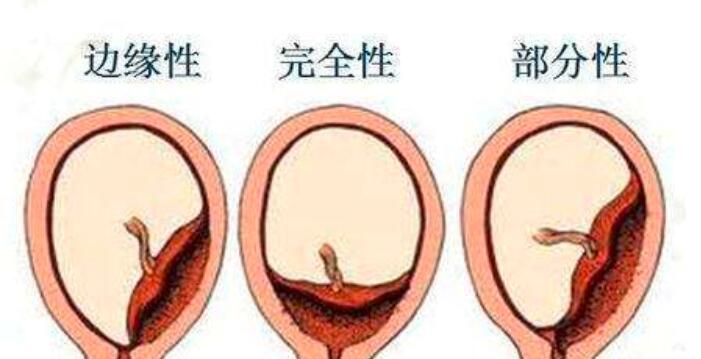 胎盘低位置怎么办_胎盘低位置的食疗方法